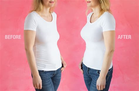 breast expansion meaning|Breast Augmentation